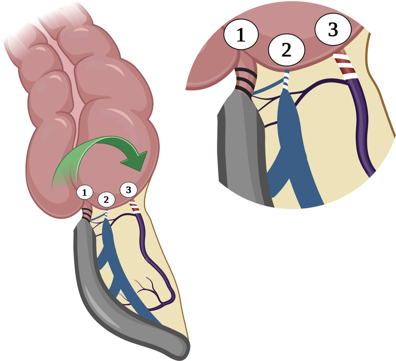 The thousand and one faces of appendicitis: Appendiceal torsion as an ...