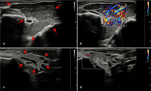 Diffusely enlarged left parotid gland with haemangioma (a), substantially increased vascularity in the left parotid gland (b), normal size and appearance of the right parotid gland (c), normal vascularization of the right parotid gland (d).