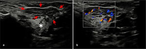 Follow-up ultrasound after 3 months: reduction in size of haemangioma (red arrows), normal appearance of left parotid gland (*) (a) marked decrease in vascularity in the left parotid gland (b).