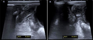 Abdominal ultrasound scan showing an appendix measuring up to 11mm with hyperechoic periappendiceal fat and a probable reginal peritoneal inflammatory response.