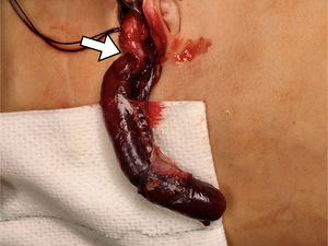 Video-assisted transumbilical laparoscopic approach with visualization of scant serous fluid and a nonpurulent appendiceal phlegmon adhered to the anterior abdominal wall and containing the vermiform appendix. Upon exteriorizing the organ, the 360° clockwise torsion of the appendix 3cm from the base could be observed that gave rise to an area of different calibre and hue (arrow). Distal to the torsion site, the appendix had a purplish gangrenous appearance, felt taut and exhibited significant venous ingurgitation, although without purulence or macroscopic perforation. However, proximal to the torsion site, the appearance of the appendix and mesentery was normal. The pathological examination found gangrenous appendicitis with areas of haemorrhage.