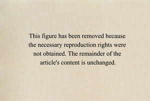 Illustration depicting the point of axial torsion of the vermiform appendix and its vessels, resulting in strangulation of (1) the appendiceal lumen, (2) the veins, with significant vascular ingurgitation, and (3) the appendicular artery with absence of blood flow, blanching due to ischaemia and, as a result, necrosis.