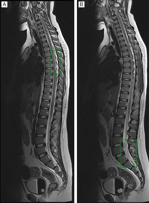 Spinal cord involvement suggested (A) acute transverse myelitis (longitudinal extensive involvement with T2 hyperintensity over more than 2/3 of the cord thickness), associated with (B) inflammatory-infectious radiculitis of the cauda equina and purulent material at the distal declive portion.
