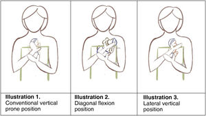 Types of kangaroo position.