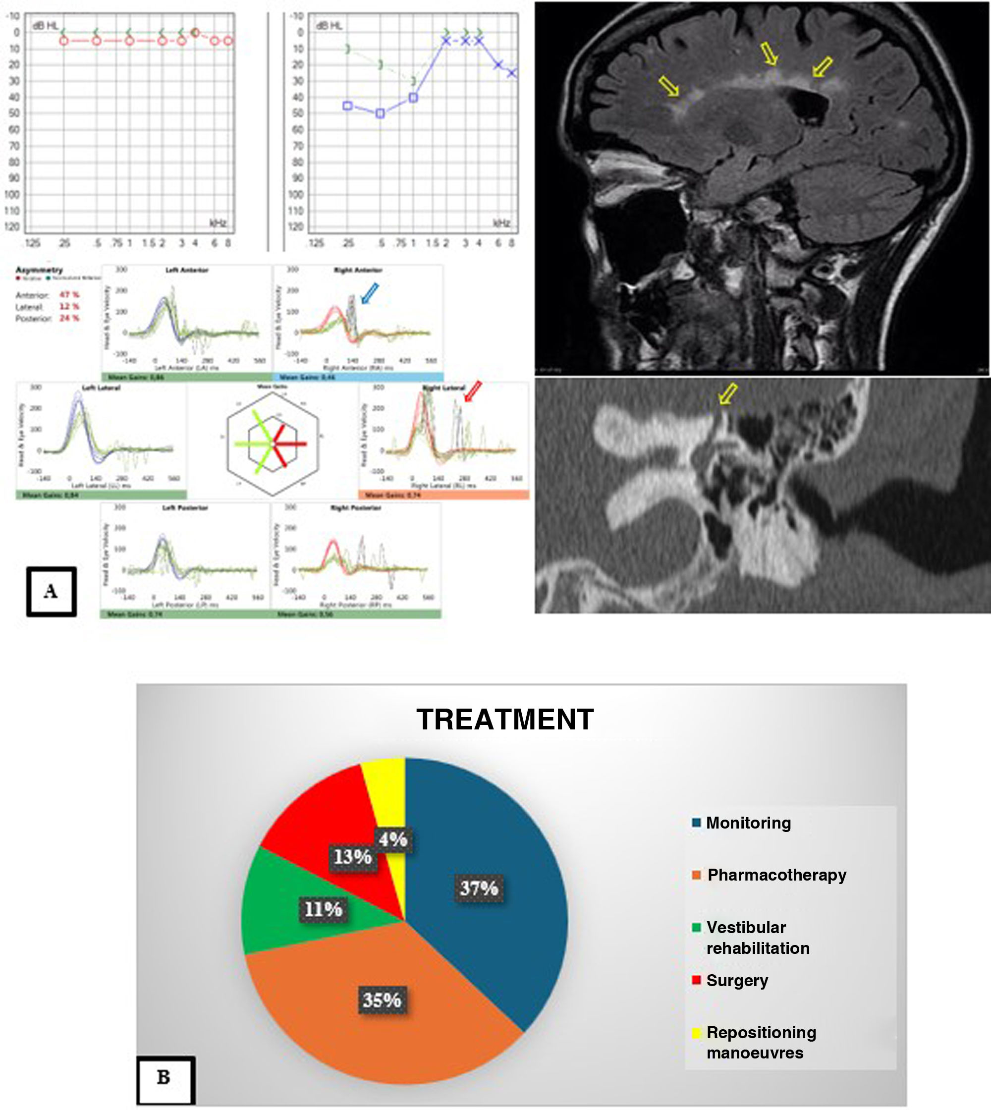 Characterization and management of vertigo in the pediatric population ...