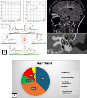 (A) Images of different diagnostic tests performed to make the diagnosis. The top left image shows the audiogram of a patient with Ménière disease of the left ear, with the characteristic pattern of low frequency hearing loss. The bottom left image corresponds to the vHIT of a patient with vestibulopathy of the right ear, with impaired function on the right side and presence of both covert (blue arrow) and overt (red arrow) saccades. The top right image shows an MRI scan of a patient with vertigo and hearing loss due to multiple sclerosis, with the characteristic feature of Dawson fingers (yellow arrows). Lastly, the bottom right image corresponds to a patient with third window syndrome due to superior semicircular canal dehiscence (yellow arrow). (B) Summary of the treatments used to manage the diseases of the patients in the cohort.