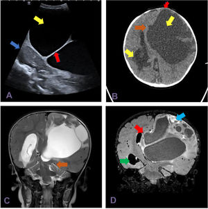 (A) Transfontanellar ultrasound with a 5–8MHzmicro-convex array transducer (sagittal plane) showing an anechoic lesion (yellow arrow), multiseptated (red arrow), with a cystic appearance, compressing the adjacent cerebellar parenchyma (blue arrow). (B) CT scan, axial view, showing a supratentorial multiseptated lesion with a large cystic component (yellow arrow). It exerted a mass effect on the metopic suture, which was bulging (red arrow), with midline shift (brown arrow), dilatation of the temporal and occipital horns of the right lateral ventricle (green arrow) and transependymal oedema secondary to hydrocephalus. (C) T2-weighted MRI of the brainstem, coronal plane, evincing descending transtentorial herniation (brown arrow). (D) Gadolinium-enhanced FLAIR MRI of the brainstem, coronal plane, showing a large cystic lesion with an enhanced peripheral solid component (blue arrow), midline shift (brown arrow) and ventricular dilatation with transependymal oedema (green arrow).