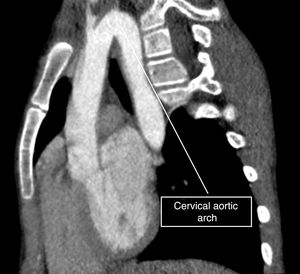 Sagittal CT image. High aortic arch superior to the clavicles.