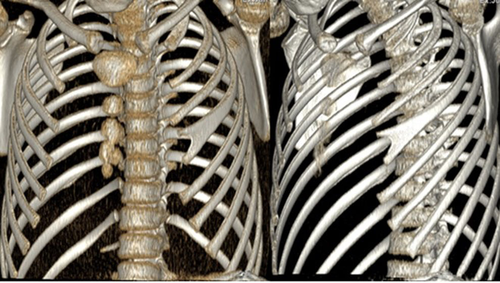 Thoracic mass as a manifestation of bifid rib | Anales de Pediatría