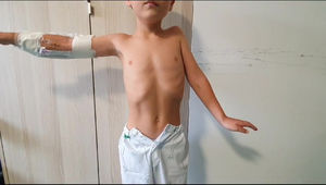 Physical examination. Marked limitation of LUE abduction. Suspected involvement of rotator cuff and deltoid muscles and musculocutaneous nerve (C5–C6).