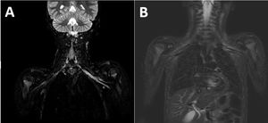 MRI with STIR hyperintensity at the level of the left brachial plexus trunks (A and B), with no discontinuity or associated masses, and signs of acute denervation with mild edema at the supraspinatus and infraspinatus muscles. Normal thickness and signal intensity in cervical spinal cord, with no evidence of space-occupying lesions in the spinal canal. Normal morphology, alignment and signal intensity in vertebral bodies, posterior elements and intervertebral discs.