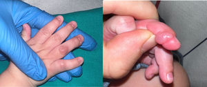 Clinical presentation of the lesion. Pink, mildly erythematous and indurated nodule in the lateral aspect of the fourth finger of the right hand. The lesion did not affect the mobility of the joint.