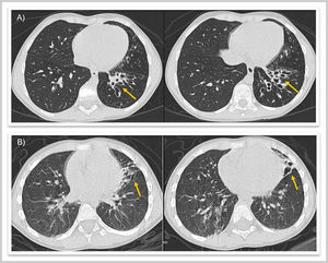 Follow-up chest CT scan five years later. (A) Case 1: cystic bronchiectasis in the left lower lobe (yellow arrow). (B) Case 2: atelectasis of the lingula with cystic bronchiectasis (yellow arrow).