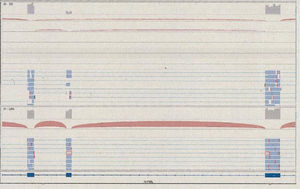 Sequencing reads covering exons 15, 16 and 17. Top: cluster of reads that support the presence of the usual transcript combined with other reads that exclude exon 16 and connect exon 15 to exon 17. Bottom: results for a control, with all reads supporting the presence of the transcript of all three exons. Source: qGenomics report.