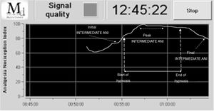 Intermediate interval ANI values in one of the patients in the hypnosis group (HG).
