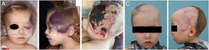 Evolution of the lesion. (A) At admission. (B) Necrotic eschar before debridement. (C) Nine months after.