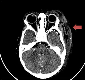 Computed tomography angiography at 24 h showing soft-tissue hematoma in the frontal and orbital regions in the absence of intracranial lesions.