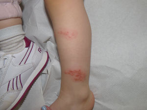 Fluid-filled blisters associated with a red rash on the medial and outer aspects of the left leg.