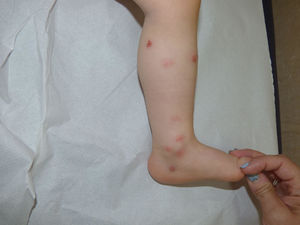 Herpes-zoster lesions on the inner aspect of the left leg.