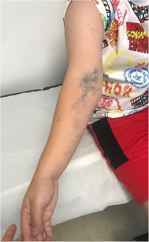 Venous malformation extending from the first digit of the right hand to the periaxillary region, spanning the ventral surface of the arm and forearm.