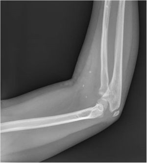 Plain radiograph. Visualization of calcifications corresponding to phleboliths.