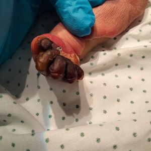 Aplasia cutis in the right upper extremity, with evidence of distal necrosis starting at the metacarpophalangeal joints (claw hand). Aplasia cutis in the right upper extremity, with evidence of distal necrosis starting at the metacarpophalangeal joints (claw hand).
