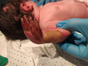Absence of dermis and epidermis in the medial surface of the right upper extremity.