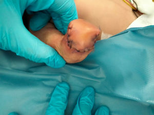 Postoperative outcome after transradial amputation.