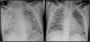 (A) Chest radiograph at admission to the intensive care unit. (B) Follow-up chest radiograph on day 2 of intravenous steroid therapy. (A) Chest radiograph at admission to the intensive care unit. (B) Follow-up chest radiograph on day 2 of intravenous steroid therapy.