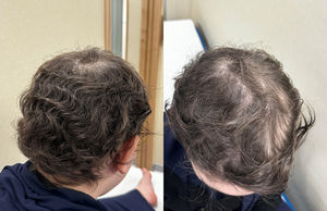 Regrowth after one year of treatment with tofacitinib. Regrowth after one year of treatment with tofacitinib.