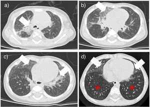 Typical chest CT features: (a–c) case 6 in Table 1; (d) case 3 in Table 1. White arrow: ground glass opacities in lingula and/or right middle lobe; red asterisk: air trapping inversion of the normal ventilatory ratio. Typical chest CT features: (a–c) case 6 in Table 1; (d) case 3 in Table 1. White arrow: ground glass opacities in lingula and/or right middle lobe; red asterisk: air trapping inversion of the normal ventilatory ratio.