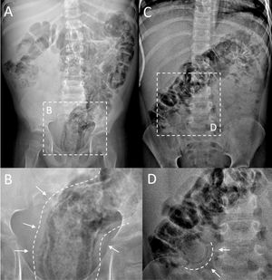 Plain radiograph of the abdomen. First patient: (A) extensive pneumatosis, more apparent in the descending and sigmoid colon and rectum; (B) expanded image of the pelvic region with clear visualization of dark streaks of air running parallel to the rectal lumen, compatible with intramural gas. Second patient: (C) involvement of hypochondrium and epigastric region characterized by distension of the intestinal lumen superimposed to multiple, less apparent features indicative of intramural gas; (D) detail showing a round streak of air corresponding to a more clearly defined area of mural pneumatosis.