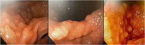 Multiple nodules in the antrum and lesser curvature of the stomach corresponding to homogeneous granular-type lateral-spreading tumors (LSTs).