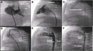 (A) and (B) Right ventriculogram, anteroposterior and lateral views showing pulmonary valve atresia (7.5 mm ring). C) Pulmonary valvuloplasty performed with a TYSHAK MINI® (NuMED) 8 × 20 mm balloon catheter advanced on a 0.0014 coronary guidewire, which traversed the ductus arteriosus to the aorta supported by a gooseneck snare. (D) Angiographic confirmation of preserved pulmonary flow after valvuloplasty. (E) Lateral aortogram showing patent ductus arteriosus and filling of right chambers. (F) Aortogram following stent placement. PV, pulmonary valve; RV, right ventricle.