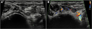 Follow-up ultrasound scan at 15 months showing a significant reduction in size (4 mm).