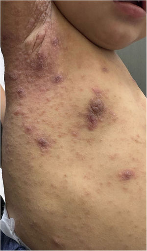 General appearance of the patient’s papulonodular lesions.