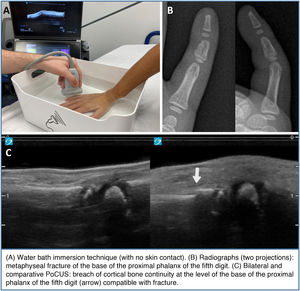 Point-of-care ultrasound for detection of hand digit fractures.