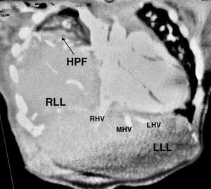 Thoracoabdominal CT angiogram. Coronal view. HPF, hepatopulmonary fusion; LHV, left hepatic vein; LLL, left liver lobe; MHV, middle hepatic vein; RHV, right hepatic vein; RLL, right liver lobe.