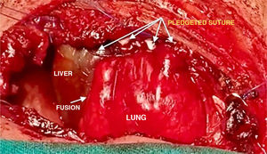 Intraoperative image.