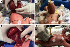 In patients with a Gastroschisis Prognostic Score of 4 (A, B), the silo is placed over the loops without bowel manipulation (C) and staged reductions performed from the top using cotton tape (D). At this time, if central venous access is unavailable, vascular access is established, preferably with a peripherally-inserted central catheter. Staged reductions are performed twice a day, based on the condition of the neonate, under sedation and analgesia with morphine. This is followed by sutureless closure with alginate dressings. Enteral nutrition starts after three days of progressive nasogastric tube clamping when drainage is less than 40 mL/day. Feeds start at 20 mL/kg/day, preferably with breast milk, for 3 days.