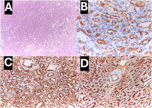 Histological analysis of the specimen. (A) Hematoxylin-eosin stain showing proliferation of small vascular structures with a nodular arrangement over a thin collagenized stroma; immunohistochemistry positive for (B) GLUT-1, (C) WT-1 and (D) CD34. Histological analysis of the specimen. (A) Hematoxylin-eosin stain showing proliferation of small vascular structures with a nodular arrangement over a thin collagenized stroma; immunohistochemistry positive for (B) GLUT-1, (C) WT-1 and (D) CD34.