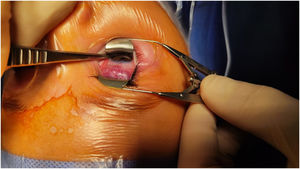 Presentation. Intraoperative image showing the gross appearance of the lesion before performance of biopsy, with visualization of a purplish mass in the posterior surface of the right upper eyelid, resembling a morula, with a vascular appearance.