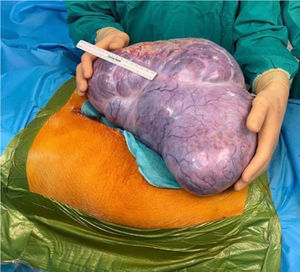 Intraoperative image: giant ovarian mass occupying the entire peritoneal cavity.