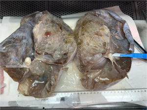 Gross appearance: multilocular cystic mass with mucinous contents and solid foci revealed upon cutting.