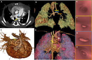 Computed tomography (CT) and volume rendering (VR) images of patient 6 showing left pulmonary artery sling. Axial CT image (A) showing a left pulmonary artery (yellow arrow) arising from the right pulmonary artery and surrounding the left main bronchus (blue arrow), consistent with left pulmonary artery sling. Volume rendering images (B, C, D) show the course of the left pulmonary artery (yellow arrow; C, D) in relation to the airways (B, C, D). Dilatation of the esophagus (white asterisk) can be perceived (D). Virtual endoscopy images (E, F, G, H) of the trachea (E), showing significant stenosis of the trachea (F), tracheal bifurcation (G) and left bronchus (H).