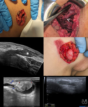 Top left: physical examination findings in case No. 1; top right: intraoperative findings in case No. 1. A large-caliber venous structure is observed in the surgical field. Based on its trajectory and topographic relationships, it was presumed to be the great saphenous vein near the saphenofemoral junction. A segmental branch arising from this vessel—already ligated at the time of the photograph—was identified as the bleeding source (white arrowhead); middle left: initial ultrasound of case No. 2, showing an extensive inguinoscrotal hematoma (white asterisk); middle right: physical examination findings of case No. 3, revealing traumatic testicular dislocation; bottom left: initial ultrasound of case No. 5, showing heterogeneous appearance and devascularization of the testis with a small associated hydrocele—findings consistent with severe testicular contusion and vascular compromise; bottom right: follow-up ultrasound of case No. 5 one year after trauma, showing marked testicular atrophy with loss of normal echogenic architecture and reduced dimensions (11.6 × 4.3 mm).