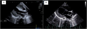 (A) Pretreatment parasternal long-axis view. (B) Post-treatment parasternal long-axis view.