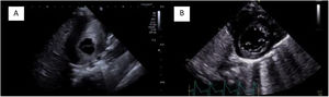 (A) Pretreatment parasternal short-axis view. (B) Post-treatment parasternal short-axis view.