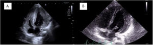 (A) Pretreatment four-chamber view. (B) Post-treatment four-chamber view.
