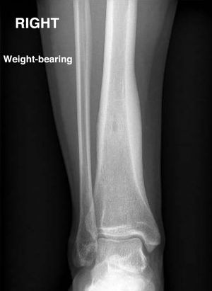 Radiograph: weight-bearing anteroposterior view of the right ankle. A punctiform cortical lesion can be seen in the distal third of the right tibia surrounded by a periosteal reaction.